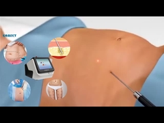Εξοπλισμός λέιζερ Lipo 30W 60W 980nm Diode Lipo Laser Machine για απώλεια βάρους